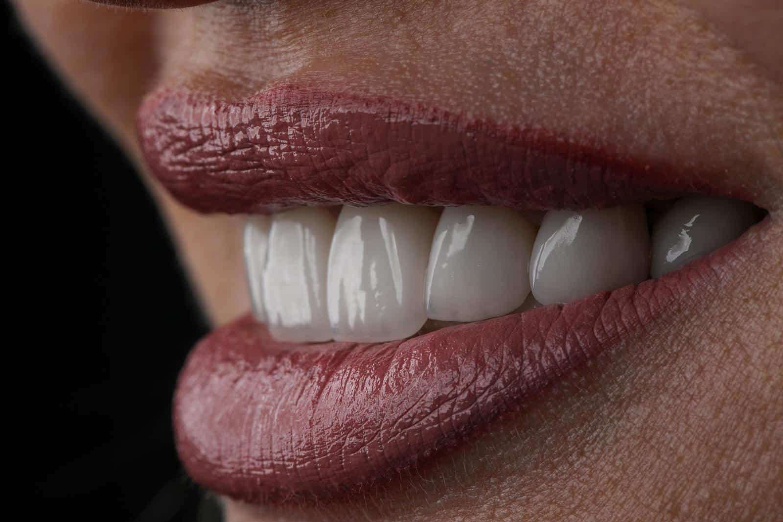Dental Aesthetics